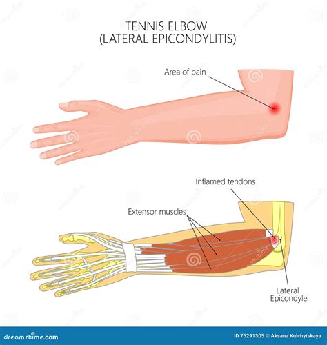 Lateral Epicondylitis or Tennis Elbow Stock Vector - Illustration of ...