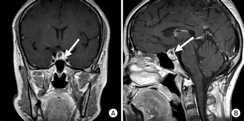 Pituitary Tumor Mri