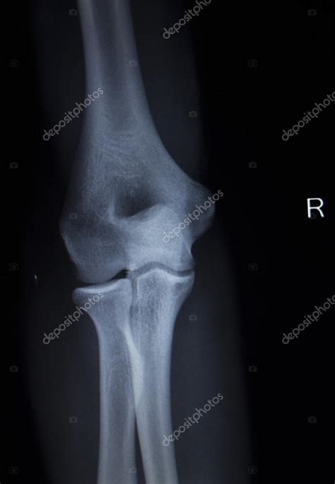 X-ray orthopedics Traumatology scan of elbow joint injury — Stock Photo © edwardolive #74476531