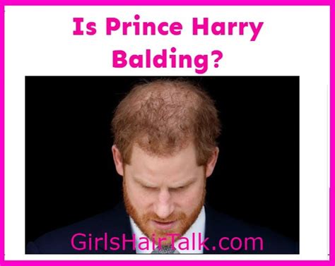 Is Prince Harry Bald What Happened To His Hair?