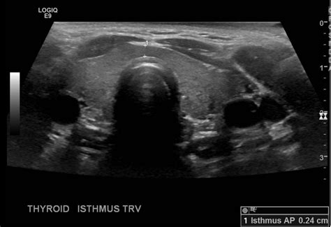 Thyroid Ultrasound Protocol – Sonographic Tendencies