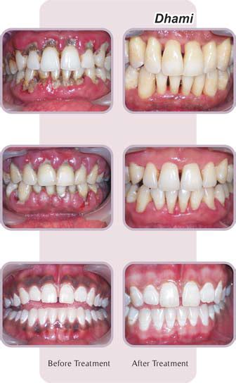 Flap surgery | Dhami Dental Clinic | Surat