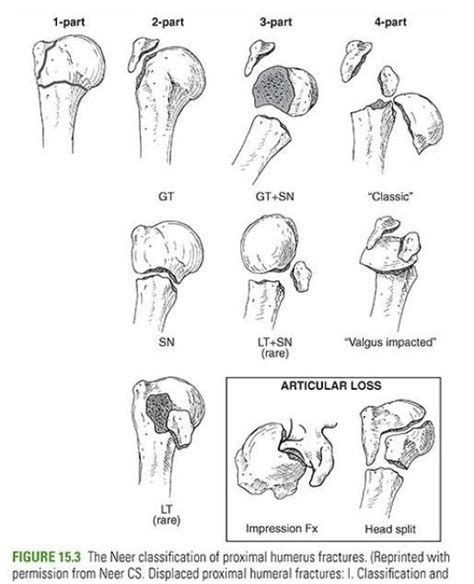 NEER PROXIMAL HUMERUS FRACTURE CLASSIFICATION - RayOrthos