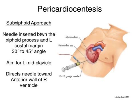 Pericardiocentesis - Just in Time Training