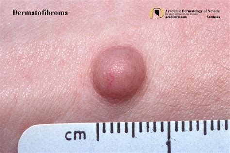 Dermatofibroma: Benign Fibrous Histiocytoma... - Academic Dermatology ...