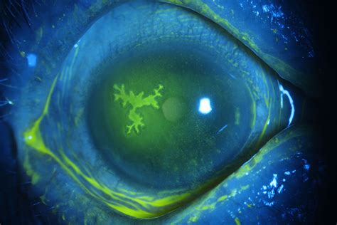 Corneal Ulcer Fluorescein