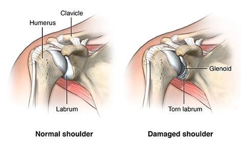 Shoulder Dislocation - Online Medical Encyclopedia - University of ...