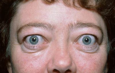 Graves' ophthalmopathy - Stock Image - C036/6335 - Science Photo Library