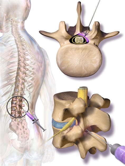 Epidural Steroid Injections - Dr. William E. Morgan