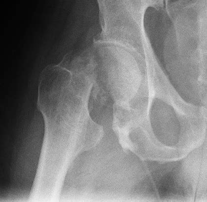 hip fracture xray – Tips From A Physical Therapist