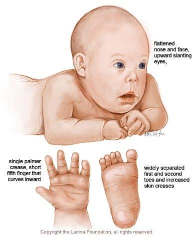 Down Syndrome: Causes, Symptoms, Treatment | SchoolWorkHelper