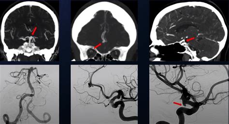 Cerebral Aneurysm Angiogram