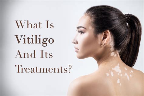 What Is Vitiligo And Its Treatment? | TatoyanMD Medspa