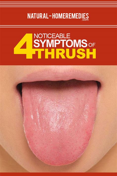 Various Noticeable Symptoms Of Thrush - Tips To Identify Symptoms Of ...