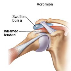 Shoulder Tendinitis Causes & Treatment | Cleveland Clinic: Health Library