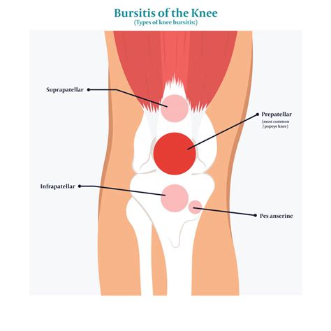 What Is Knee Bursitis What Are Its Symptoms Causes And Treatment My ...