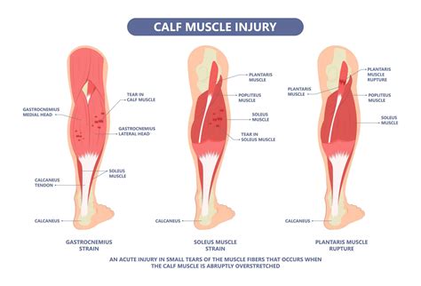 Calf Muscle Pain | Causes of Calf Muscle Pain | Sore Calf Muscle