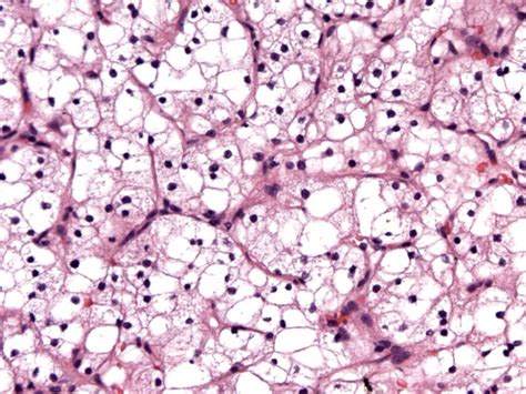 RCC Histology Clear Cell - KCCure