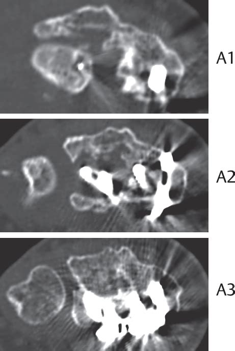 Intra- and Extra-articular Malunion | Musculoskeletal Key