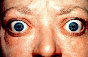 Graves' ophthalmopathy - Wikipedia