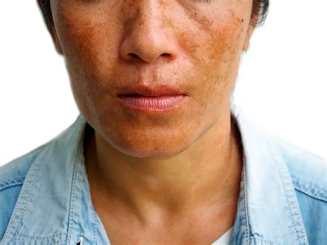 Melasma: Causes, Symptoms and Treatments | STD.GOV Blog