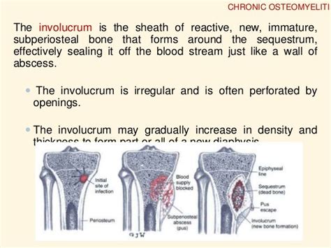 Osteomyelitis