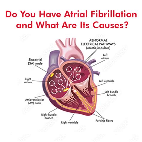 Atrial Fibrillation and What Are Its Causes? | Dr Raghu