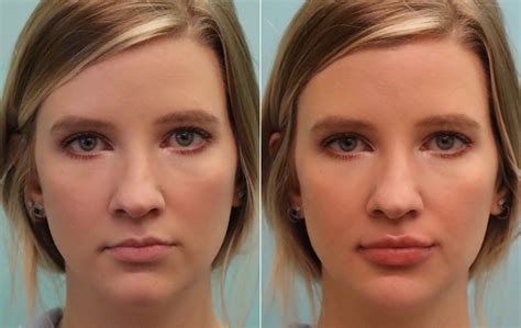 Lip Augmentation photos | Chevy Chase, MD | Patient 16303