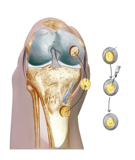 Knee Cartilage Reconstruction, Artwork Photograph by D & L Graphics ...