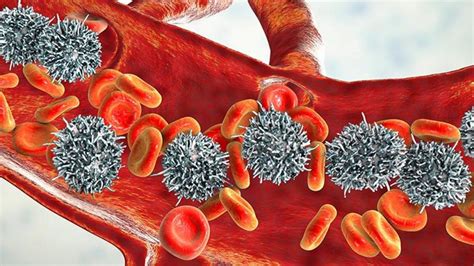 ¿Qué es la leucemia crónica? | Síntomas, causas y cómo tratar la enfermedad