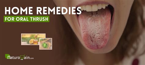 11 Best Home Remedies For Oral Thrush To Prevent Infection