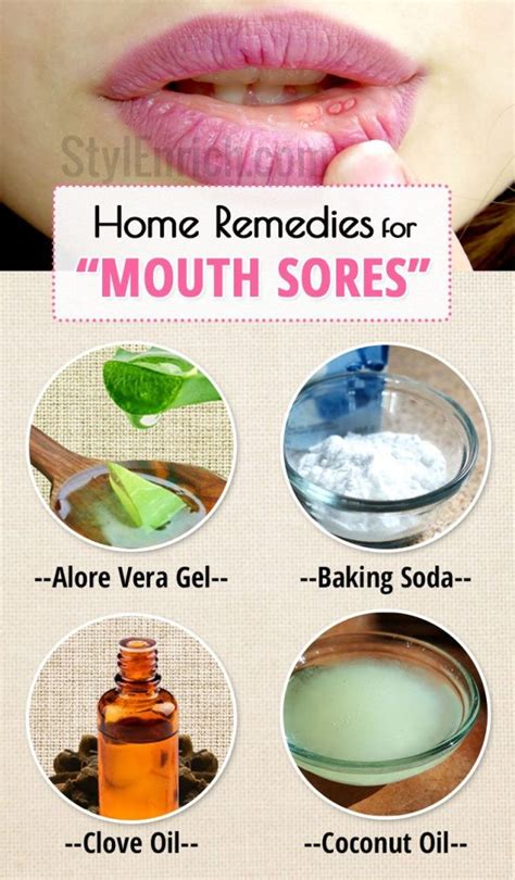 Home Remedies for Mouth Sores or Canker Sores