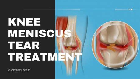 Torn Meniscus Symptoms Archives - Dr. Ramakant Kumar