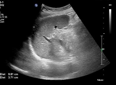 (Ch:25) Ultrasound of the Spleen – EFSUMB