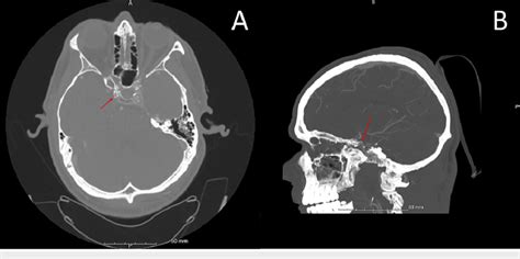 CT angiogram of the head, axial cut (A) and sagittal cut (B ...