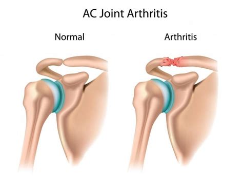 Shoulder Acromioclavicular (AC) joint osteoarthritis: Orthopedic Center ...