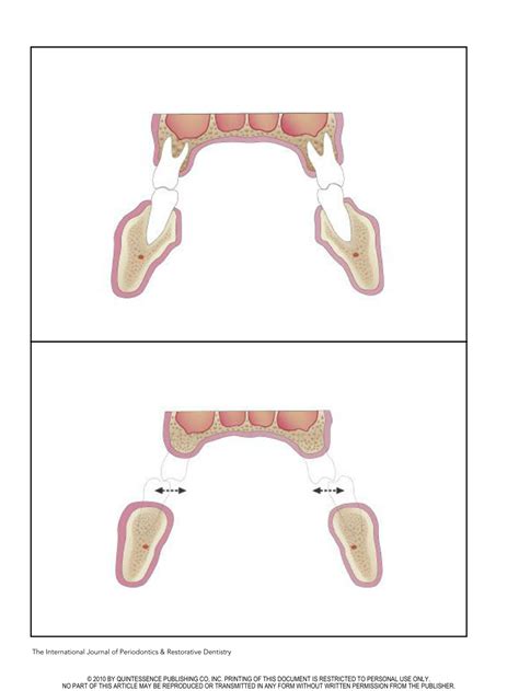 (PDF) An Interarch Alveolar Ridge Relationship Classification