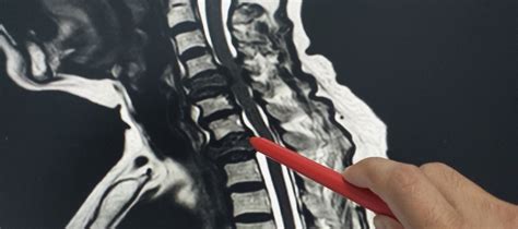 Cervical Spine MRI | I-MED Radiology Network