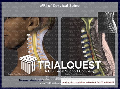 MRI of Cervical Spine - TrialQuest Inc.