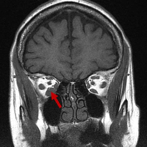 New diagnosis of Graves Orbitopathy