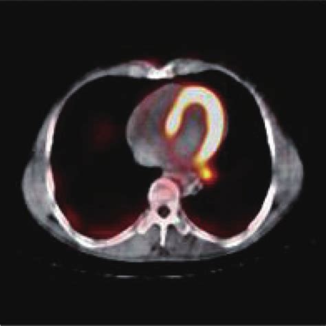 A representative patient with a metastatic mediastinal lymph node as ...