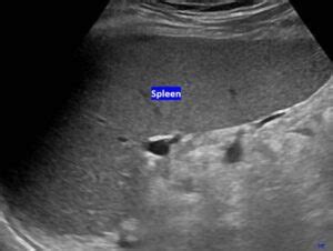 Spleen Ultrasound – How to Measure Length of the Spleen and Assess for ...