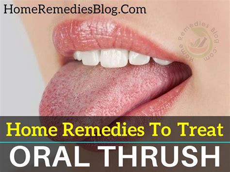 11 Proven Home Remedies To Treat Oral Thrush Naturally - Home Remedies Blog