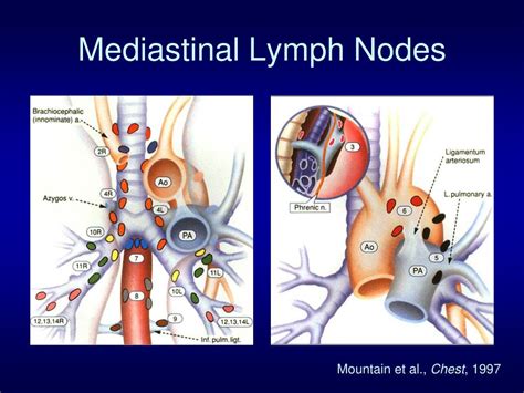 Stage 2 Cancer Lymph Nodes