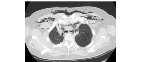 CT scan showing both mediastinal emphysema and subcutaneous emphysema ...