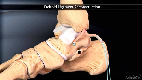 Deltoid Ligament Injury - Injury Choices