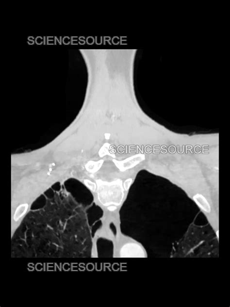 Emphysema, X-ray | Stock Image - Science Source Images