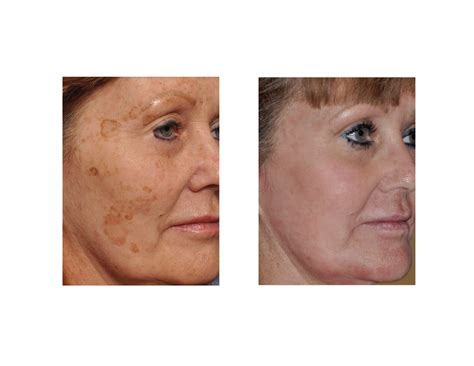 Laser Treatment For Brown Spots On Face