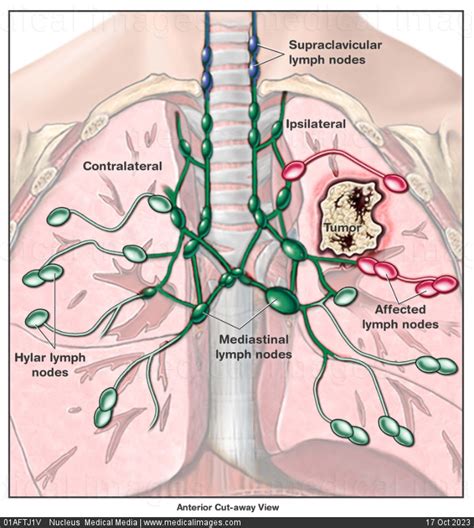 Hilar Lymph Nodes Lung Cancer