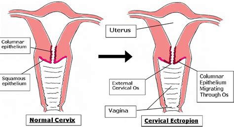 Cervical Ectropion - Causes, Symptoms & Cervical Ectropion Treatment